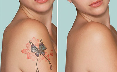 Выведение татуировок